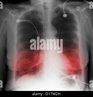 CXR ältere Raucher mit COPD Stockfoto