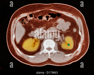 CT-Untersuchung des Abdomens mit kleinen Nierenstein Stockfoto