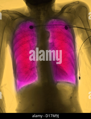 CXR Seniorin Rauchers mit COPD Stockfoto