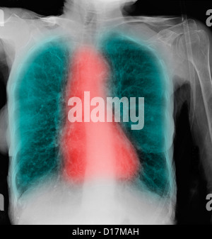 CXR Seniorin Rauchers mit COPD Stockfoto