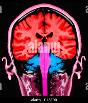 MRI Gehirn Sagital Abschnitt normal Stockfoto