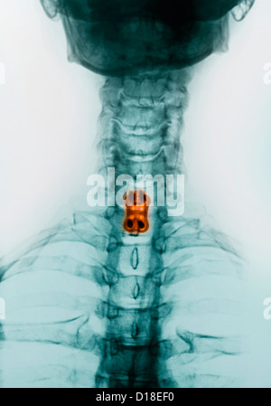 Halswirbelsäule Xray, Spondylodese, Schrauben, Platte Stockfoto