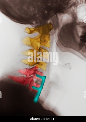 Zervikale Xray zeigt Spondylodese, C5, C6, C7 Stockfoto