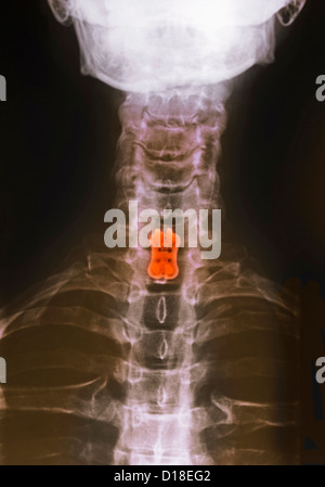 Halswirbelsäule Xray, Spondylodese, Schrauben, Platte Stockfoto