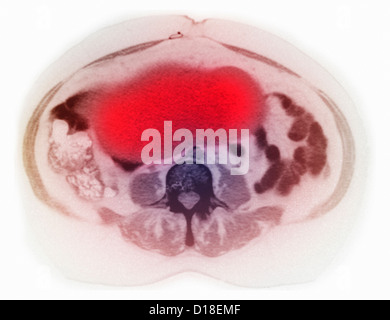 Eierstockkrebs auf CT-scan Stockfoto