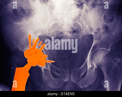 X-ray ein künstliches Hüftgelenk in ein 56 Jahre alter Mann Stockfoto