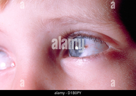 MALIGNES MELANOM DER HORNHAUT LIMBUS Stockfoto