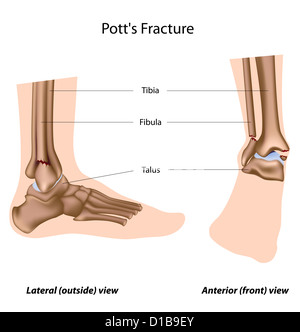 Pott Fraktur Stockfoto