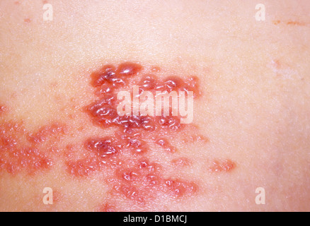 Herpes zoster Stockfoto, Bild: 280236642 - Alamy