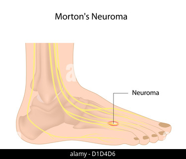 Morton Neurom Stockfoto