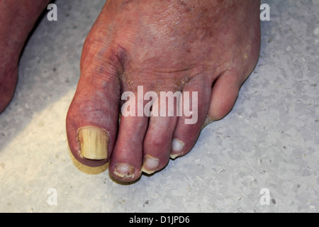 Fuß und Zehen auf ein 88 Jahre Alter älterer Mann zeigt Pilz auf Fußnägel und Psoriasis am Fuß sowie Onychomykose Nägel Stockfoto