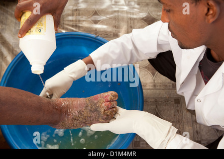 Ein Patient erhält Behandlung für Podoconiosis (Elephantiasis) in der Hidase Klinik in Debre Markos, Äthiopien. Stockfoto