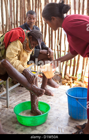 Ein Patient erhält Behandlung für Podoconiosis (Elephantiasis) in der Hidase Klinik in Debre Markos, Äthiopien. Stockfoto