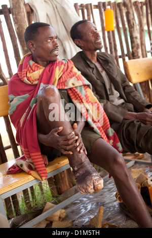 Ein Patient erhält Behandlung für Podoconiosis (Elephantiasis) in der Hidase Klinik in Debre Markos, Äthiopien. Stockfoto