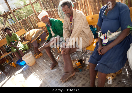 Ein Patient erhält Behandlung für Podoconiosis (Elephantiasis) in der Hidase Klinik in Debre Markos, Äthiopien. Stockfoto