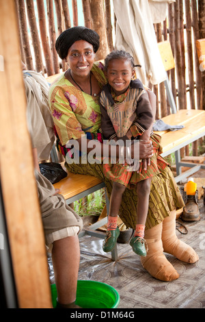 Ein Patient erhält Behandlung für Podoconiosis (Elephantiasis) in der Hidase Klinik in Debre Markos, Äthiopien. Stockfoto