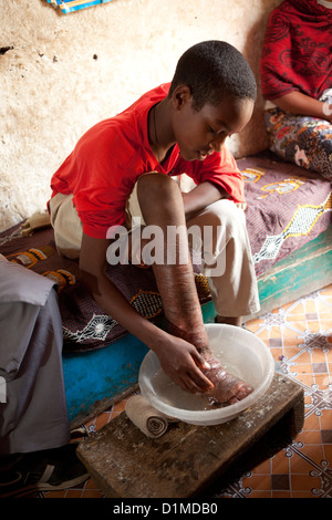 Eine Jugend erhält Behandlung für Podoconiosis (Elephantiasis) in Addis Abeba, Äthiopien. Stockfoto