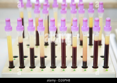 Essen, Deutschland, Messung der Erythrozyten Sedimentation Rate in einem zytologischen Labor Stockfoto