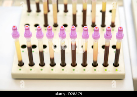 Essen, Deutschland, Messung der Erythrozyten Sedimentation Rate in einem zytologischen Labor Stockfoto