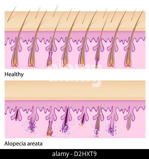 Normales Haar und Alopecia areata Stockfoto