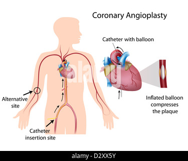 Koronarangioplastie Stockfoto