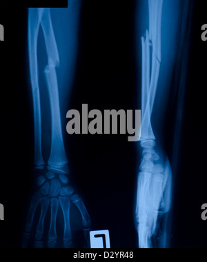 X-Ray Film des proximalen Radius-Fraktur Stockfoto