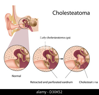 Cholesteatom Stockfoto