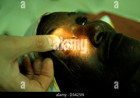 Patienten mit einem Zimbawean Dorf wo die fliegenden Ärzte in flog Cateract Augenoperationen auf Menschen vor Ort durchführen Stockfoto
