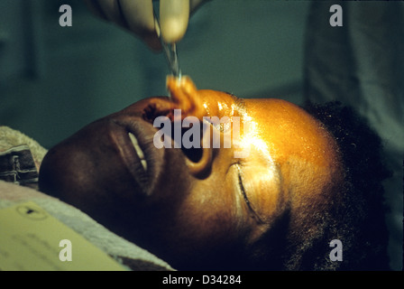 Patienten mit einem Zimbawean Dorf wo die fliegenden Ärzte in flog Cateract Augenoperationen auf Menschen vor Ort durchführen Stockfoto