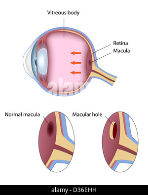 Makulaforamen Stockfoto