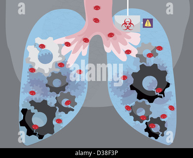 Anschauliches Bild der menschlichen Lunge von einem Virus infiziert Stockfoto