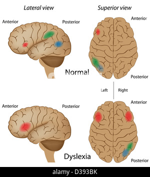 Legasthenie-Gehirn-Aktivität im Vergleich zu normalen Stockfoto