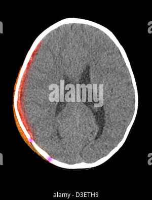 CT-Scan zeigt Kopfhaut Hämatom, subdurale Hämatom und Schädelbruch bei einem 20 Monate alten Kind Stockfoto