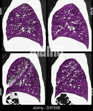 CT-Scan zeigt zystische Fibrose der Lunge Stockfoto