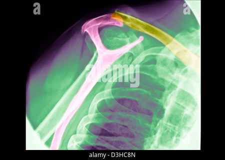 GEBROCHENEN SCHLÜSSELBEIN, X-RAY Stockfoto