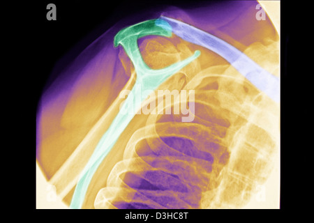 GEBROCHENEN SCHLÜSSELBEIN, X-RAY Stockfoto