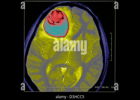 ZYSTE IM GEHIRN, MRT Stockfoto
