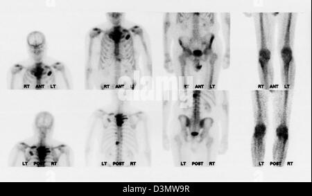 Knochen-Scan zeigt mehrere Metastasen Stockfoto