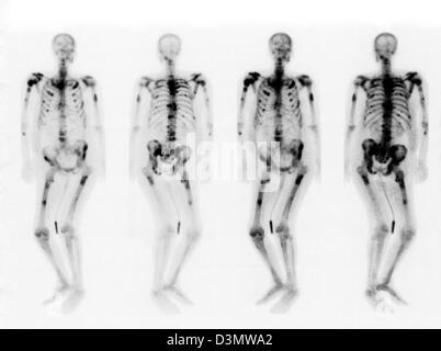 Knochen-Scan zeigt mehrere Metastasen Stockfoto