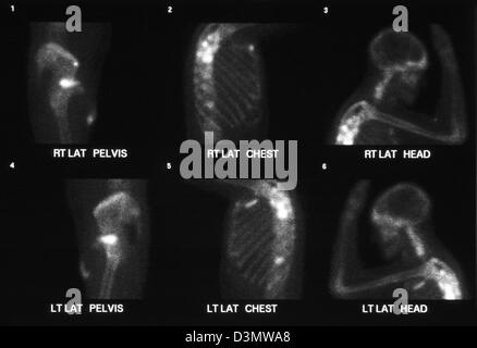 Knochen-Scan für Krebs zeigt mehrere Metastasen an der Schulter, Rippen, Becken, Humerus, Femur und Wirbelsäule Wirbel Stockfoto