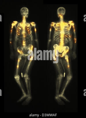 Knochen-Scan zeigt mehrere Metastasen Stockfoto
