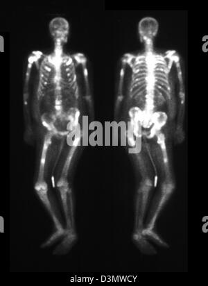 Knochen-Scan zeigt mehrere Metastasen Stockfoto