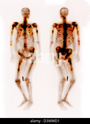 Knochen-Scan zeigt mehrere Metastasen Stockfoto