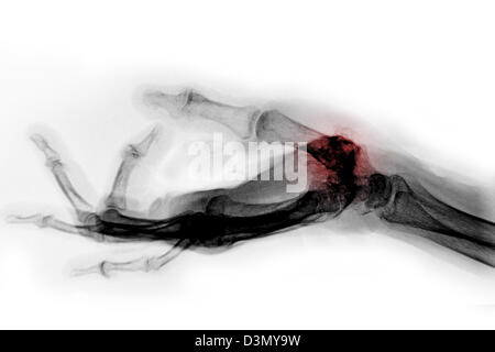 Röntgen der Hand eines älteren Mannes mit degenerativen arthritischen Erkrankungen an der Basis des Daumens Mittelhandknochen Stockfoto