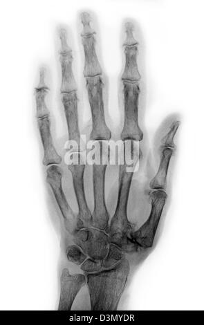 Röntgen der Hand eines älteren Mannes mit degenerativen arthritischen Erkrankungen an der Basis des Daumens Mittelhandknochen Stockfoto