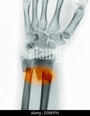 x-ray zeigen eine distale Radius und Ulna Fraktur in ein 12 Jahre altes Mädchen Stockfoto