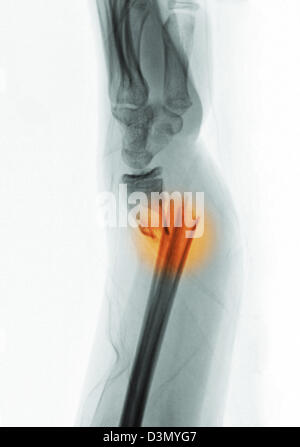 x-ray zeigen eine distale Radius und Ulna Fraktur in ein 12 Jahre altes Mädchen Stockfoto