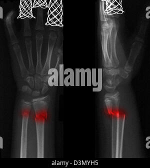 x-ray zeigen eine distale Radius und Ulna Fraktur in ein 12 Jahre altes Mädchen Stockfoto