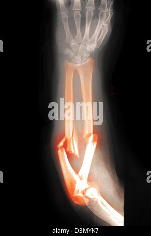 x-ray zeigt eine stark abgewandelte und zerkleinertem Fraktur des Unterarms Stockfoto