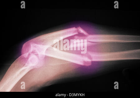 x-ray zeigt eine stark abgewandelte und zerkleinertem Fraktur des Unterarms Stockfoto